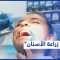 شاهد.. طبيب الأسنان أمير عجم يتحدث عن فوائد عمليات زرع الأسنان ومخاطرها